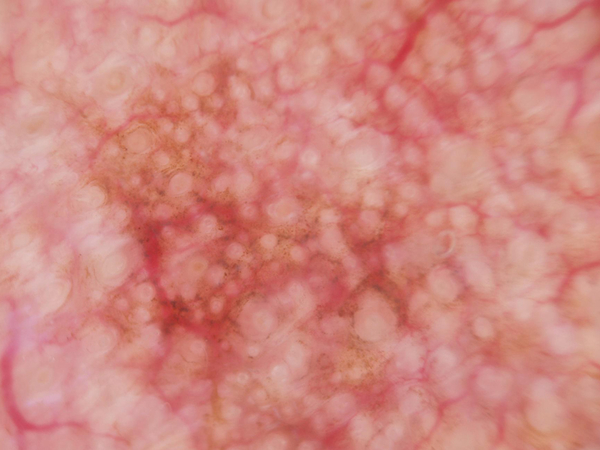 Actinic keratosis lesion sample